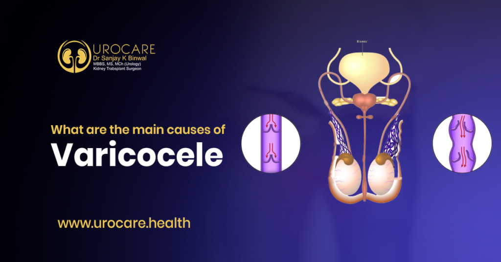 causes of varicocele