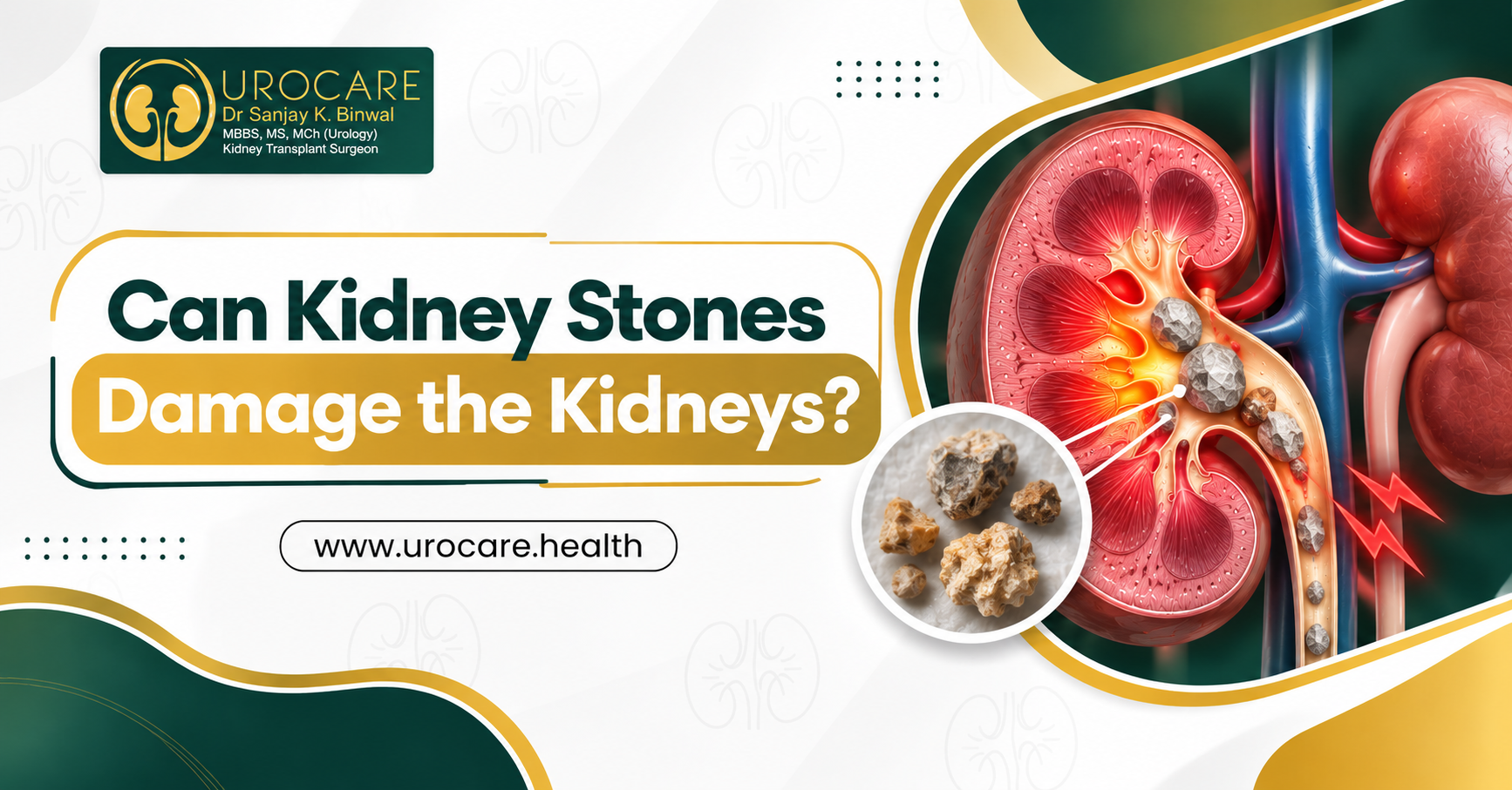 Can Kidney Stones Damage the Kidneys?